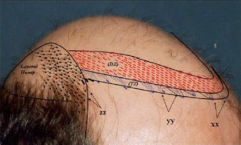 Frontal Hairline Design: Stepwise Approach | Harleys Clnic