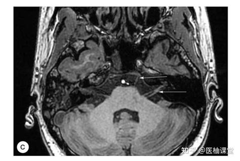 脑组织铁沉积神经变性病临床与影像诊断（二）_signal