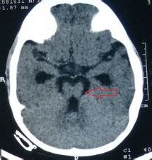 Molar tooth sign | Pediatric Oncall Journal