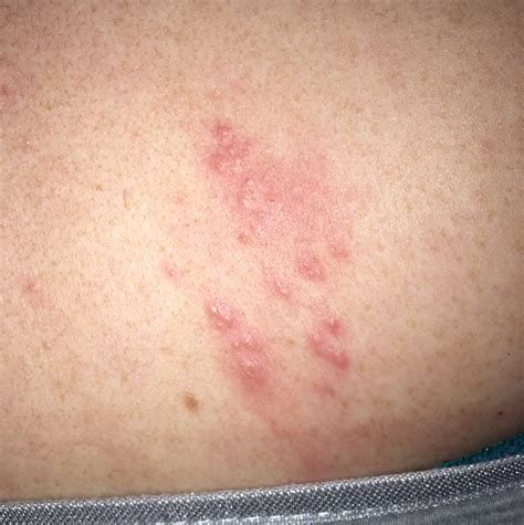 List 97+ Pictures Pictures Of Dermatitis On The Back Latest 10/2023