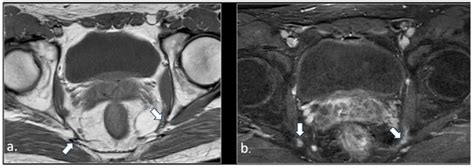MRI in Chronic Pudendal Neuralgia: Diagnostic Criteria and Associated ...