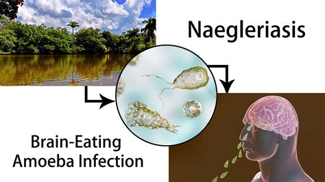 Does Soap Kill Brain Eating Amoeba at Caitlin Hume blog