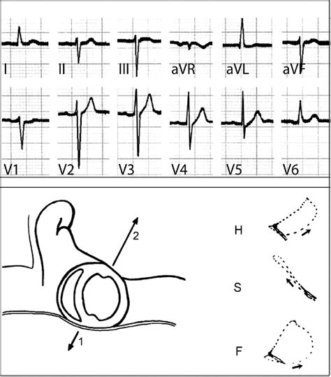 Hemiblocks Revisited | Circulation