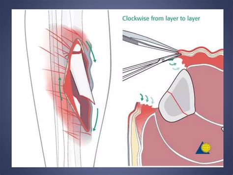 Image result for Open Fracture Surgery