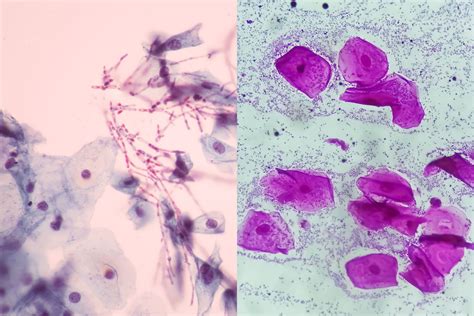 Bv And Yeast At The Same Time
