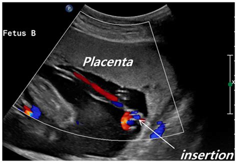 Bildergebnis für velamentous umbilical cord ultrasound