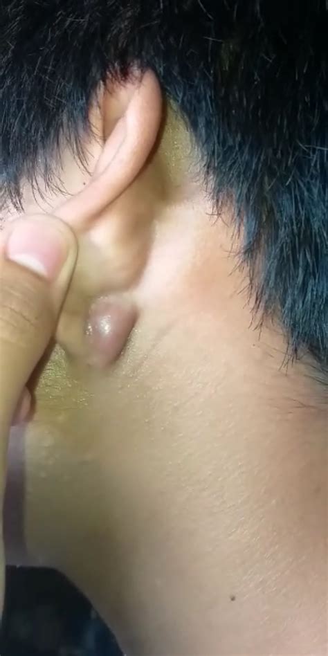 Painful Cyst Behind Ear