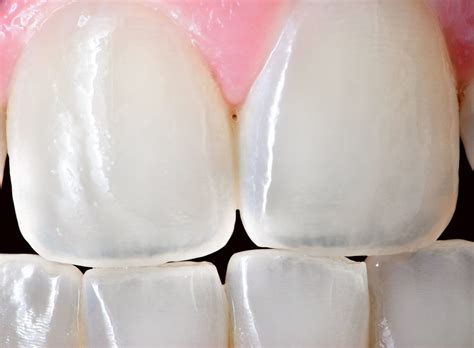 Tooth Enamel Acid Erosion