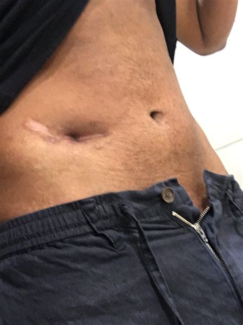 Appendicitis Scar Removal