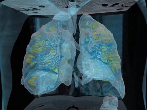 Coronavirus completely clutches lungs, US doctors release 3 D video ...