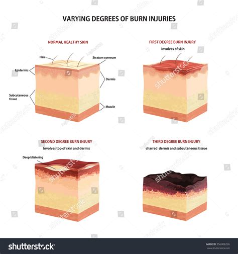 What Is The Difference Between First Degree Burns And Third Degree ...