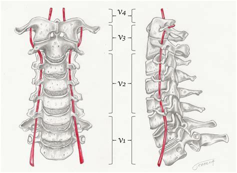Intraoperative Vertebral Artery Injury - Orthopedic Clinics