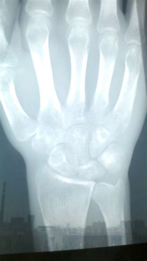 右手腕舟骨骨折5个月，能不能打篮球啊？拍片子显示，骨折线模糊，断端对位良好，腕关节骨质疏松.._百度知道