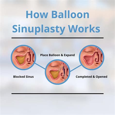 Sinus Balloon Surgery After Care at Max Monte blog