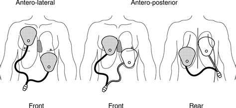 Image result for Synchronized Cardioversion Pad Placement