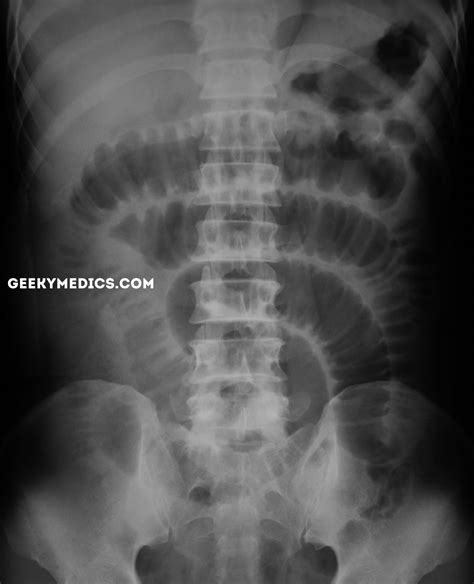Normal Abdominal X Ray Gasless Abdomen In The Adult: What Does It