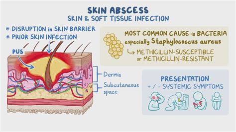 Image result for Staphylococcus Aureus Pathogenicity