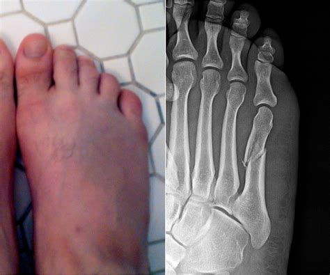 Top of foot hairline fracture - coursesquest
