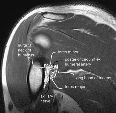 Quadrilateral Space Syndrome - Journal of Vascular and Interventional Radiology