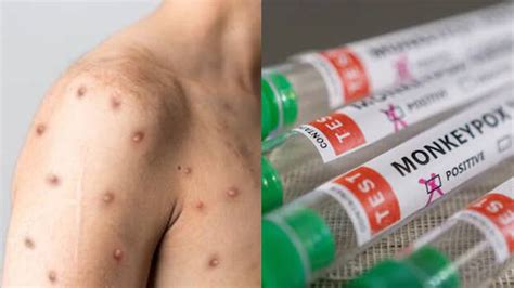 Monkeypox confirmed in Kerala again, youth from UAE contracts disease ...