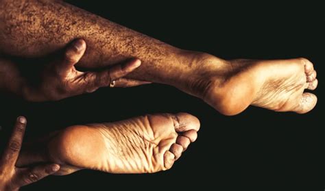 Skin Peeling on Feet: Causes and Remedies - Feet First Clinic