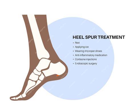 Premium Vector | Calcaneal spur treatment Foot problem diagnostic and consult in podiatry clinic ...