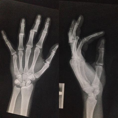 Dislocated Finger X Ray