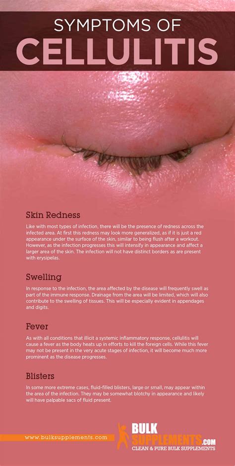 Eye Infection Cellulitis at Larry Cyr blog