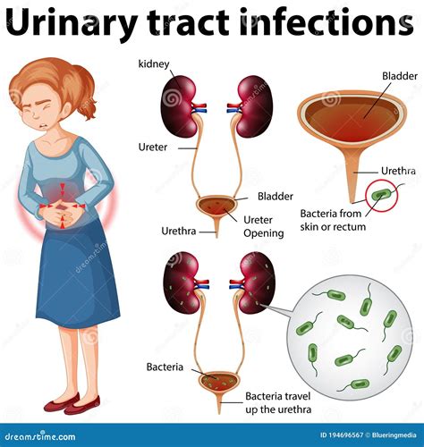 Informative Illustration of Urinary Tract Infections Stock Vector ...