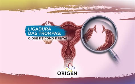 Ligadura De Trompas Memes