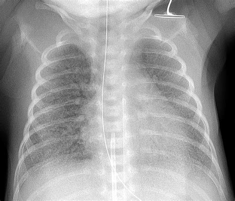 Chest X Ray Findings In Neonatal Respiratory Distress Syndrome at Luz ...