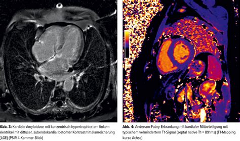 Kardiale Magnetresonanztomografie bei Herzinsuffizienz - Kardiologie ...