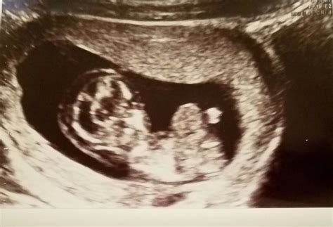 New here. NT scan showed CH and omphalocele. | BabyCenter