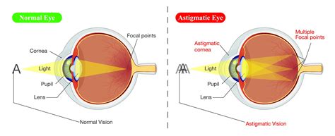 Stigmatism Vs Astigmatism