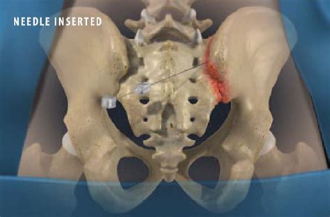 SI Joint injection 2 | STL MISC