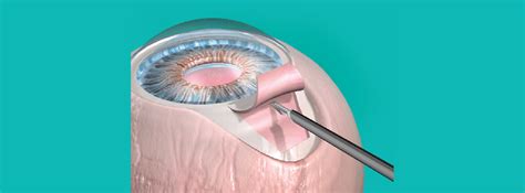 Glaucoma Surgery|Eye Specialist in Jabalpur |Daksh Netralaya