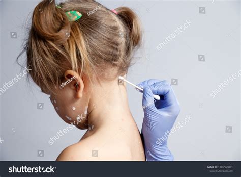 Calamine Lotion Chicken Pox