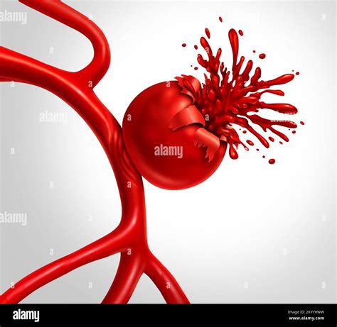Ruptured Aneurysm as a medical concept with a bulging blood vessel as a ...