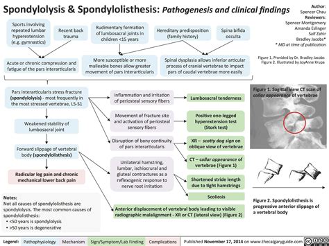 Difference between spondylosis and spondylolysis. Spondylosis vs Spondylolysis: Understanding ...