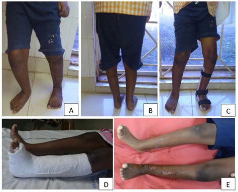 Split transfer of tibialis anterior for equinovarus foot deformity in ...
