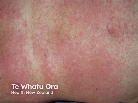 Rash Pictures SJS 的图像结果