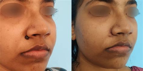 Swelling | Moles | Plastic surgery - AMICUS CLINIC
