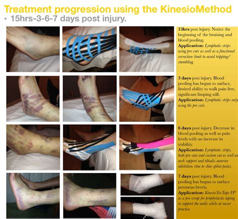 High Ankle Sprain Swelling