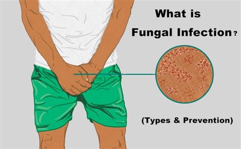 Fungal Infection (Types & Prevention) – Nuutjob