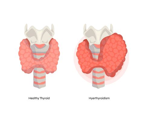 PCOS And Hyperthyroidism: Things You Must Know!