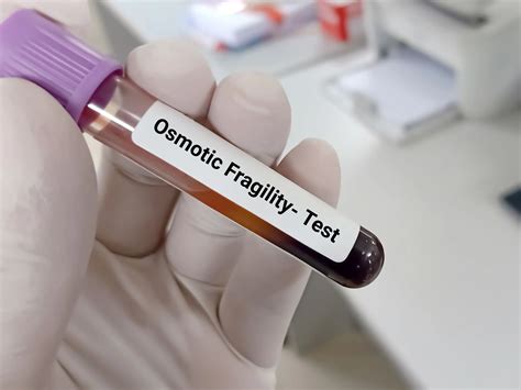 Osmotic Fragility Test: Purpose, Results & How It Works | Credihealth