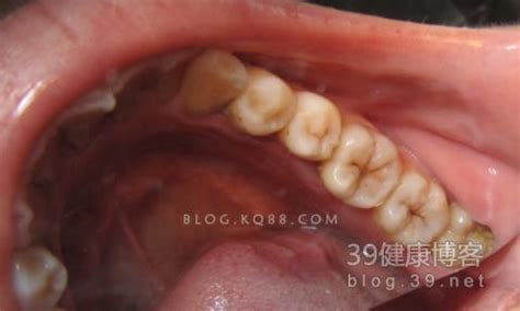 智齿冠周炎--你真的全面对待了么？---刘-卫文娟的博客-KQ88口腔博客