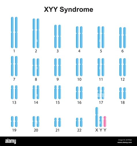 Progettazione scientifica della sindrome di Jacobs (XYY) Karyotype. Simboli colorati ...