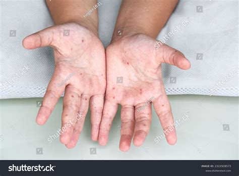 Herpes On Palms Of Hands