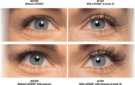 Latisse-Eyelash-Serum - Chicago MedSpa & Aesthetics